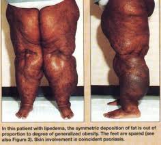 Stages of Lipedema.  European Society of Lymphology